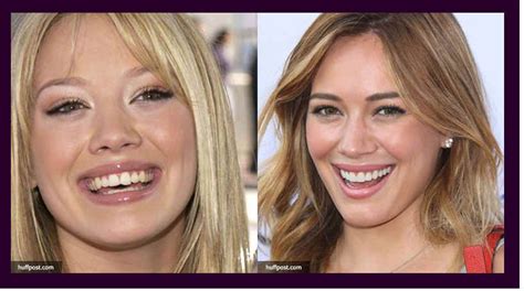 Celebrities With Dental Implants Or Cosmetic Dentistry Before