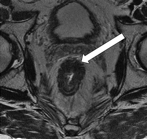 Mri Of Rectal Cancer Tumor Staging Imaging Techniques And Management