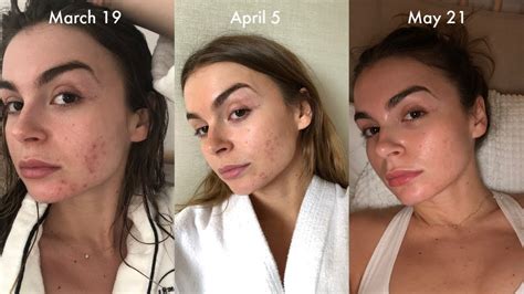 How I Cleared My Acne And Scarring In 3 Months With 3 Products Youtube