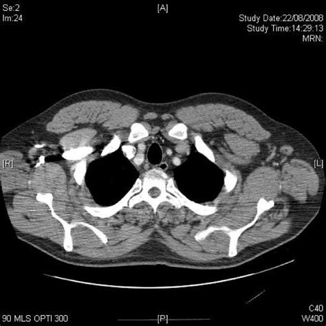 Axial Ct Of Upper Abdomen Demonstrates Mildly Enlarged Para Aortic And