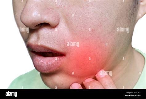 Swelling At The Cheek Of Asian Man Abscess Formation Stock Photo Alamy