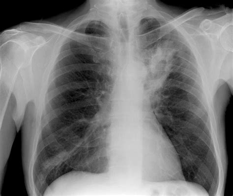 Lung Abscess X Ray Photograph By Du Cane Medical Imaging Ltd Pixels