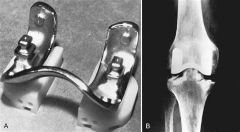 Historic Development Classification And Characteristics Of Knee Prostheses Musculoskeletal Key