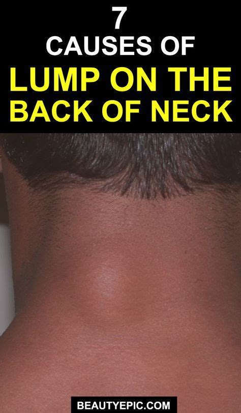 Causes For Lump On The Back Of Neck Skin Bumps Epidermoid Cyst Neck