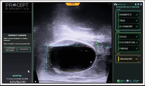 PDF HOW I DO IT How I Do It Aquablation Of The Prostate Using The A Qua B Eam System