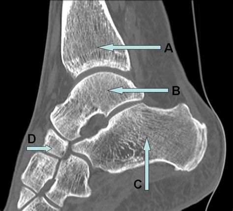 Sagittal Computed Tomography Of The Ankle The Bmj