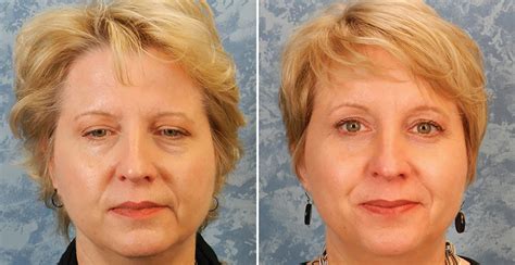 Brow Lift Before And After Pictures Plastic Surgeon Dallas Roberts