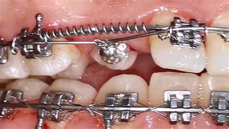Pulling Out An Impacted Canines By Braces And Double Wire Techinque