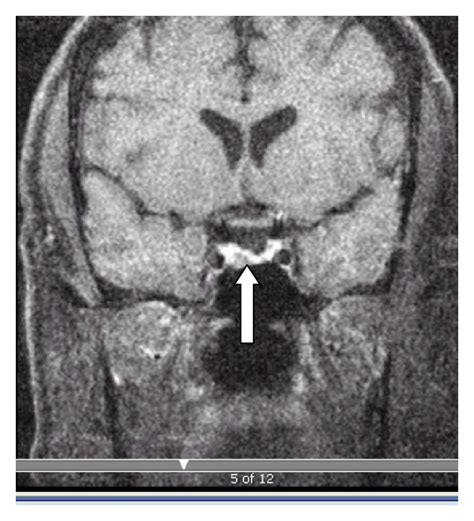 Pituitary Mri Post Contrast Showing Microadenoma Thick Arrow