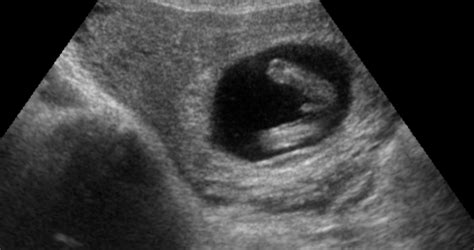 Early Gender Test At 13 Weeks 3d 4d Hd Ultrasound Virginia