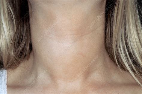 Goiter Hypothyroidism