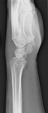 Triquetral Fracture Radiology Case Radiopaedia Org