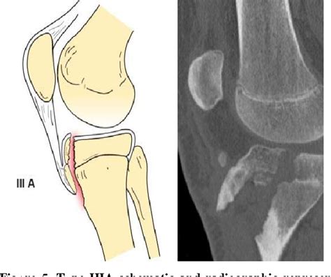 Figure From Imaging Review Of Adolescent Tibial Tuberosity Fractures
