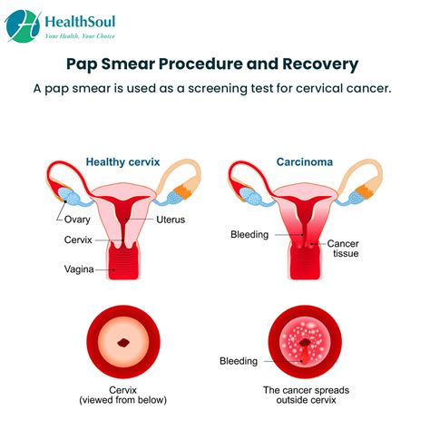Pap Smear Test How Much Does A Pap Smear Cost Momcute