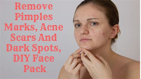 Remove Pimples Marks Acne Scars And Dark Spots Diy Face Pack Makeup