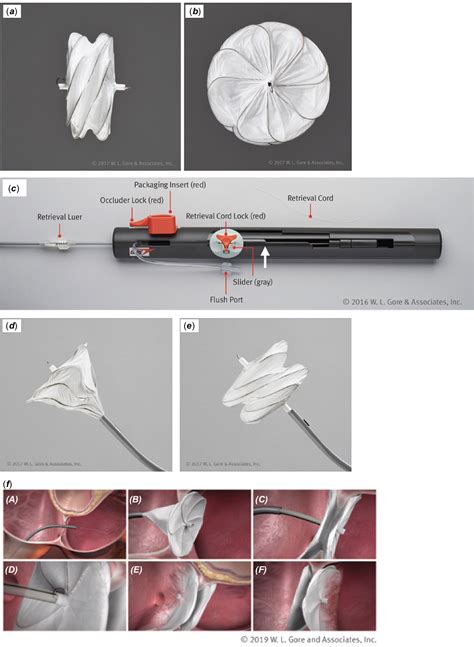 Gore Cardioform Atrial Septal Occluder Deployment Procedure And