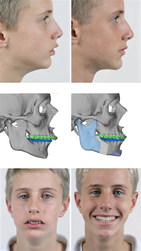 Bottom Jaw Surgery Before And After Girlycop