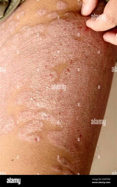Diseases Caused By Abnormalities Of The Lymph Psoriasis Is A Skin