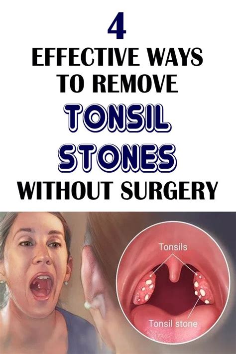 How To Remove Tonsil Stones Back Of Throat Howtormeov