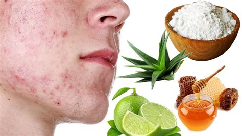 4 cara alami menghilangkan bekas jerawat home remedies for acne marks youtube