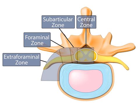 The Difference Between Bulging Disc And Herniated Disc