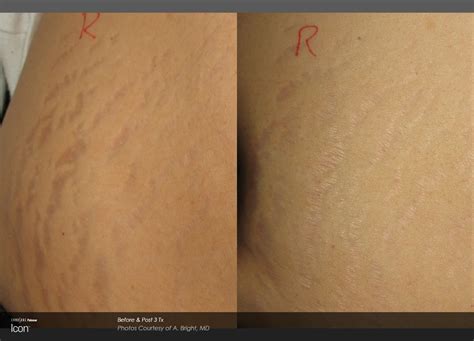 Stretchmarks In Northville Stretch Marks Treatment Near Me
