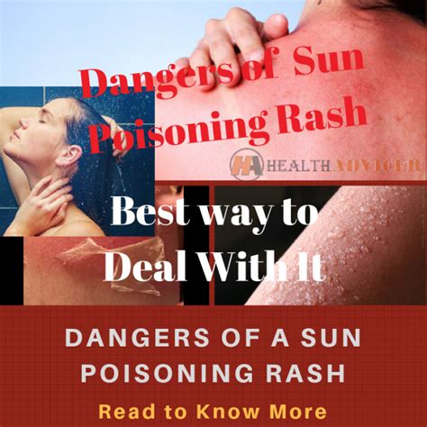Sun Poisoning Symptoms Pictures Causes And Treatments
