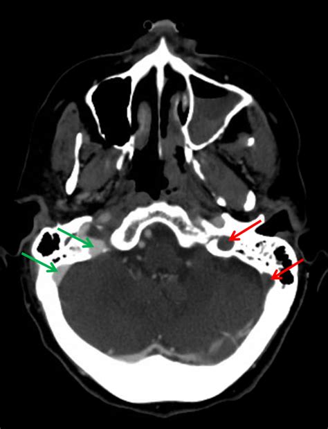 Septic cavernous sinus thrombosis secondary to acute bacterial sinusitis: CaseStacks.com — Case #17 — Dural venous and cavernous ...