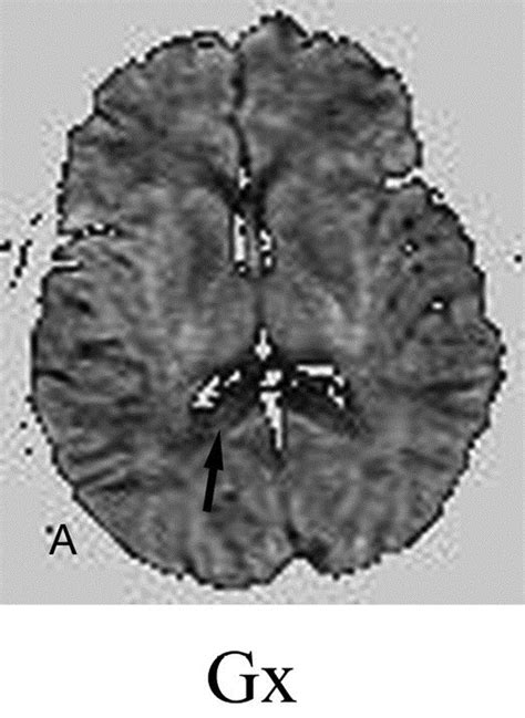 Diffusion Mr Imaging Of Acute Ischemic Stroke Neuroimaging Clinics