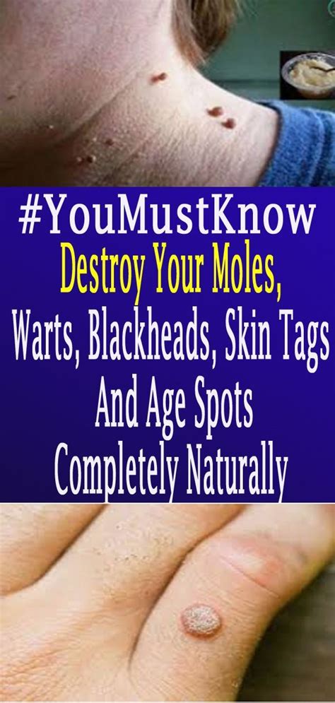 Health Tips Skin Tag Skin Moles Skin