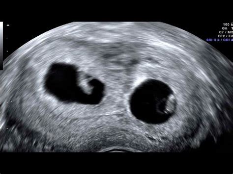6 weeks pregnant belly pictures. 2D ultrasound 6 weeks pregnant twins nice funny Rafael ...