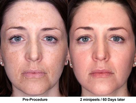 Acid Peels The Treatment For Wrinkles Age Spots And Fine Lines Heidi