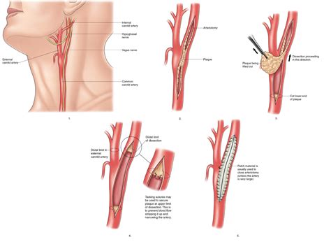 Carotid Endarterectomy Surgery Vascular Surgery Vascular Surgery