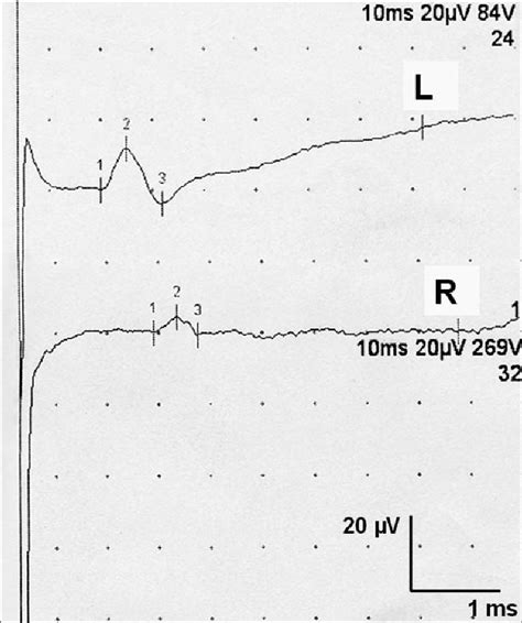 Entrapment Of The Lacn Lateral Antebrachial Cutaneous Nerve