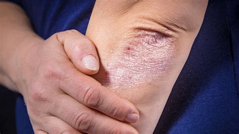 Scabies Rash What Is A Scabies Rash