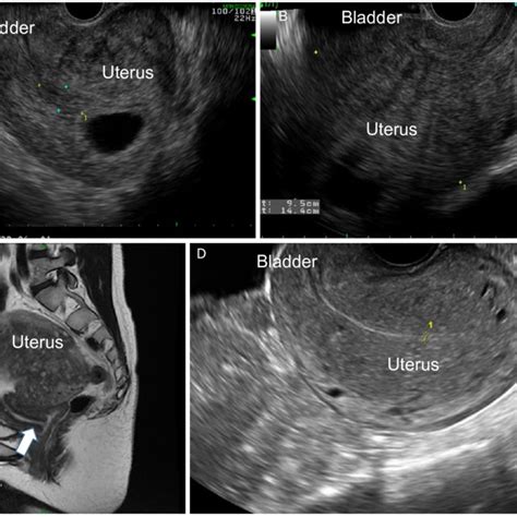 transvaginal ultrasound demonstrates a a retroverted gravid uterus download scientific