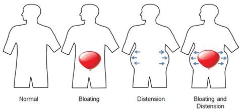 Do You Know The Difference Between Abdominal Bloating And Distention