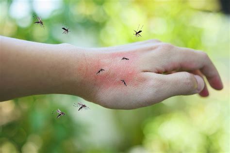 Mosquitoes Bite On Adult Hand Made Skin Rash And Allergy Pointe Pest Control Chicago Pest