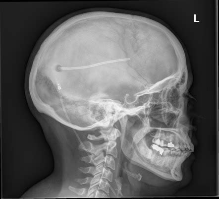 Shunt Series Radiology Reference Article Radiopaedia Org