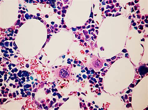 Bone Marrow Functions Stem Cells And Transplants Owlcation