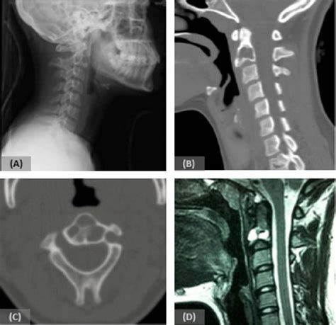 Transoral Vertebroplasty For A C2 Aneurysmal Bone Cyst The Spine Journal