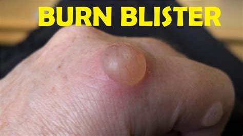 How To Treat A Burn Blister On Finger Youtube