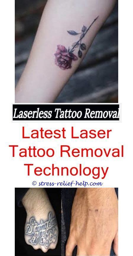 If the skin already has irregularities such as scarring expect that to remain after laser tattoo removal. Will tattoo removal scar.Does having a tattoo removed hurt ...