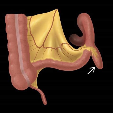 Meckel Diverticulum