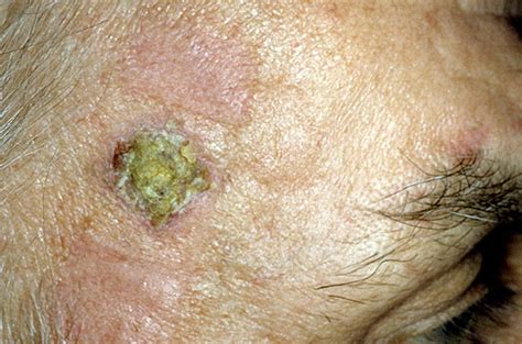 Skin Cancer On Face Pictures 33 Photos And Images