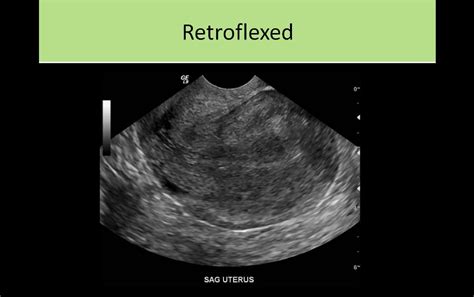 Retroflexed Uterus Medical Ultrasound Ultrasound Sonography Ultrasound