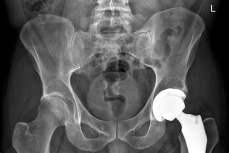 I Got My Hip Replaced At 39 Heres Why That Might Get More Common