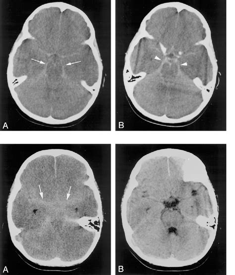 Figure 2 From Pseudo Subarachnoid Hemorrhage A Potential Imaging