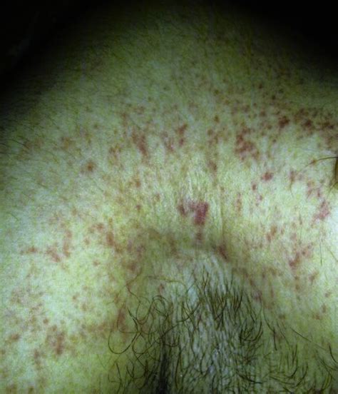 Evidence Of Petechial Rash Over The Upper Trunk Download Scientific
