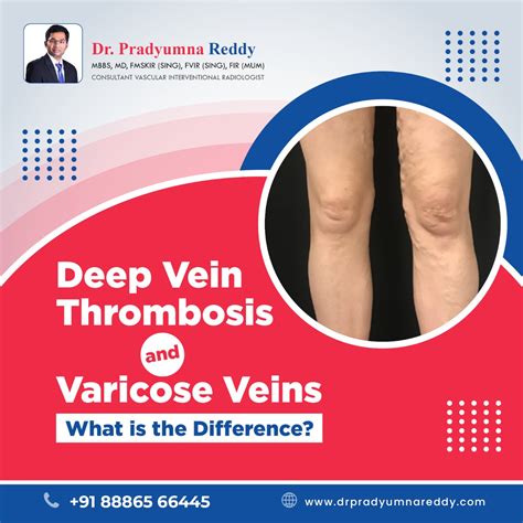 Deep Vein Thrombosis And Varicose Veins What Is The Difference